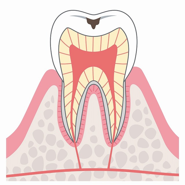 C1（エナメル質のむし歯）
