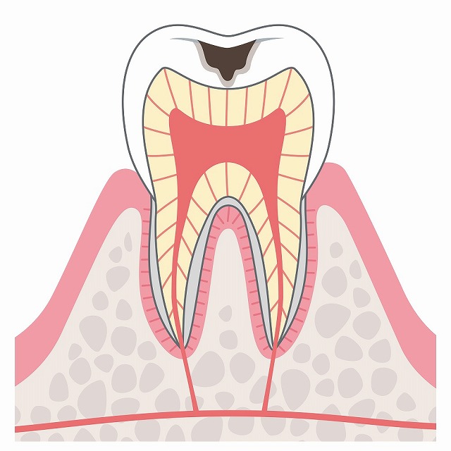 C2（象牙質のむし歯）