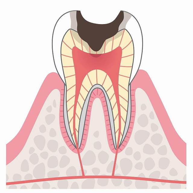 C3（神経に達したむし歯）