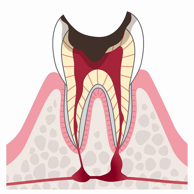 C4（根の部分しか残っていないむし歯）