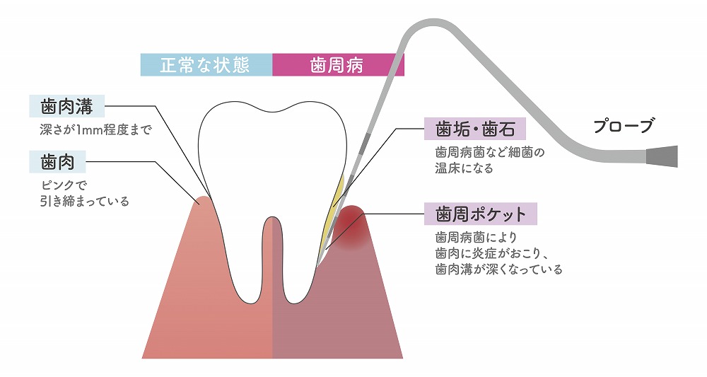 骨が溶ける『歯周病』とは？