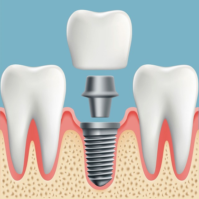 失った歯を補う『インプラント治療』